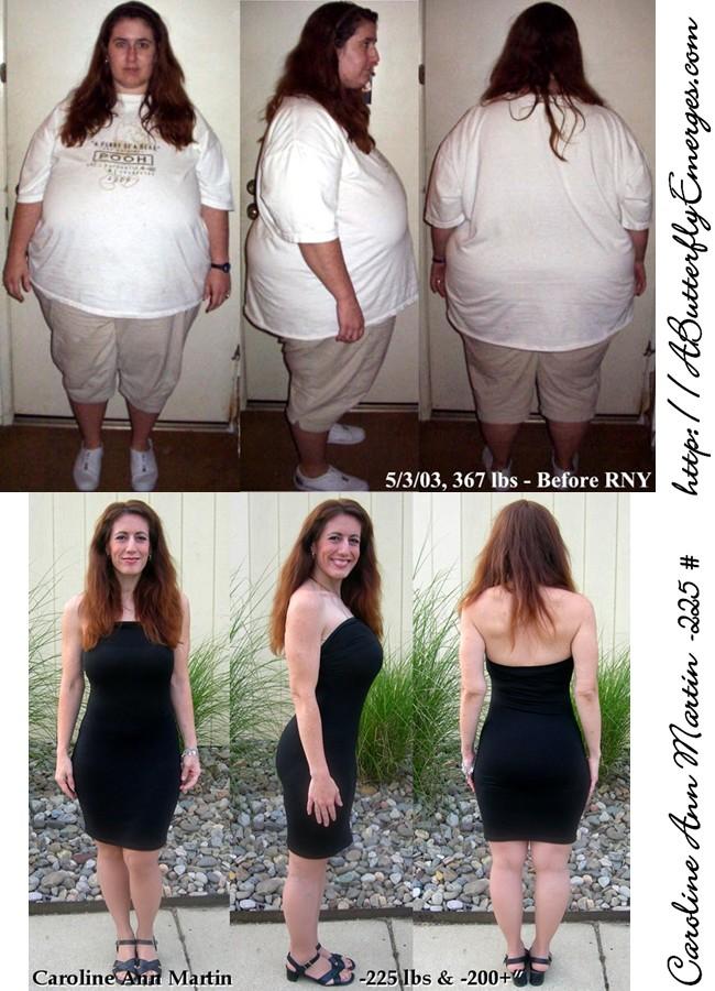 Caroline Ann Martin Before and After Losing 225 lbs - the bottom photo was taken about 7 months after my last reconstructive surgery to remove excess